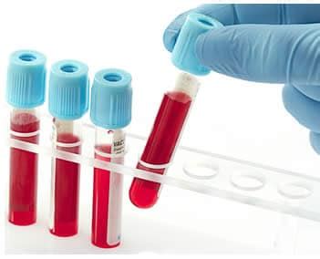 pdw analisi del sangue.